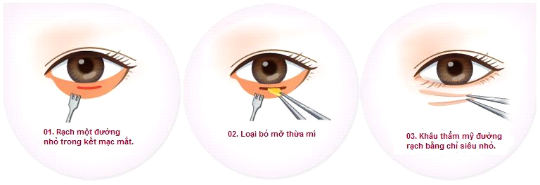 cắt mỡ bọng mắt