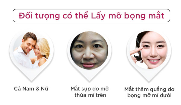Lấy mỡ bọng mắt an toàn với kỹ thuật Hàn Quốc - Ảnh 3