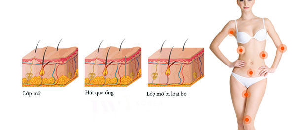 Mô phỏng phương pháp hút mỡ toàn thân Laser Lipo.