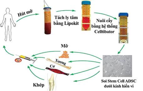 Có ai nâng ngực bằng mỡ tự thân chưa Có ai nâng ngực bằng mỡ tự thân chưa