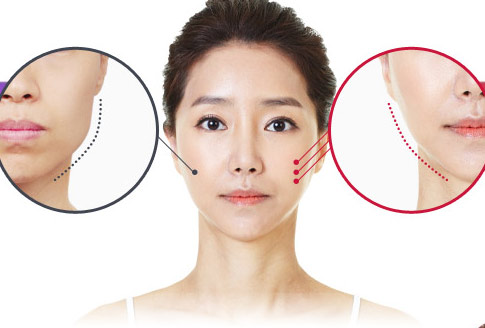 Gọt mặt giá bao nhiêu Gọt mặt giá bao nhiêu
