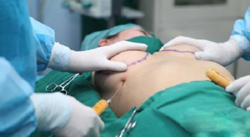 Hậu quả nâng ngực bằng mỡ tự thân Hậu quả nâng ngực bằng mỡ tự thân