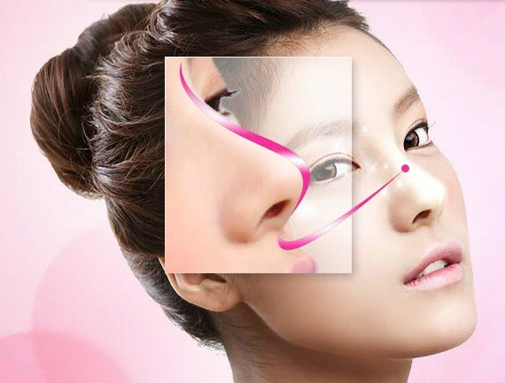 Nâng mũi S Line Hàn Quốc an toàn
