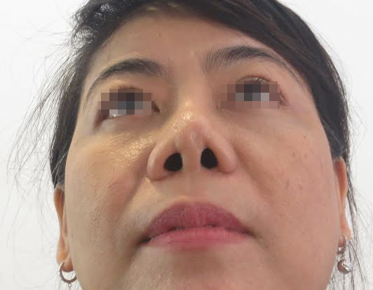Nâng mũi giá rẻ Nâng mũi giá rẻ