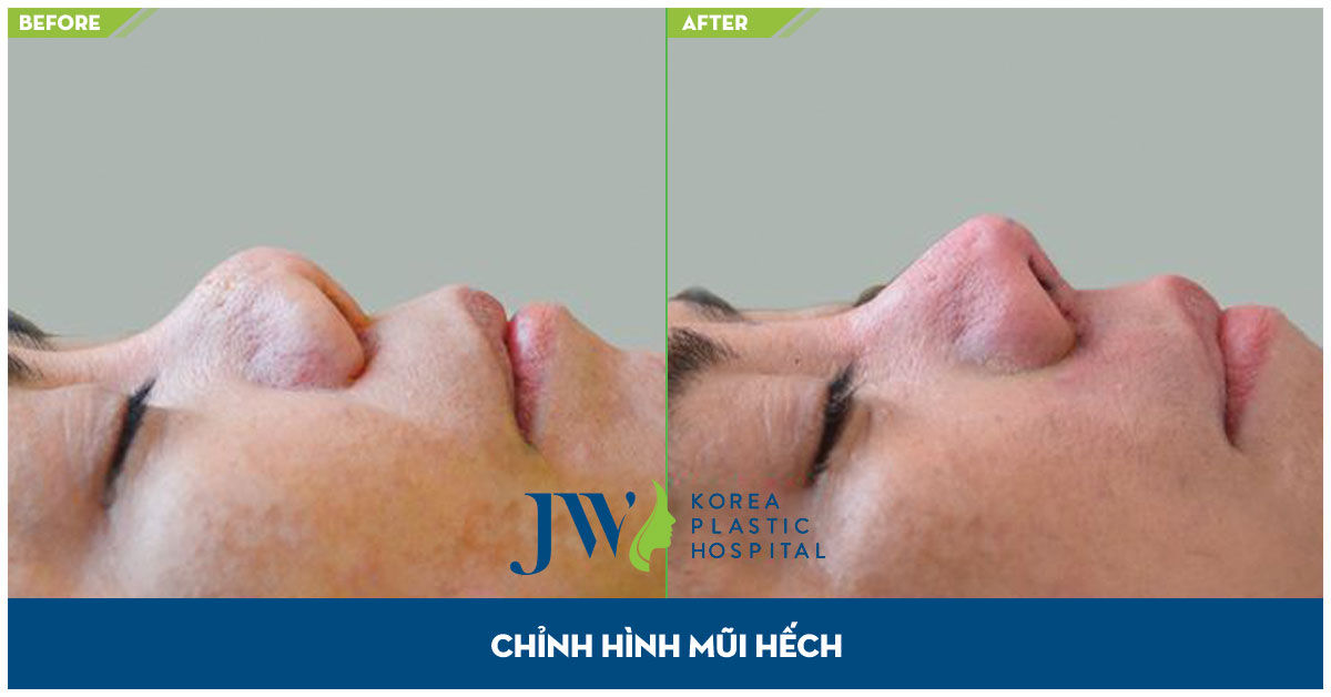 chinh-mui-hech