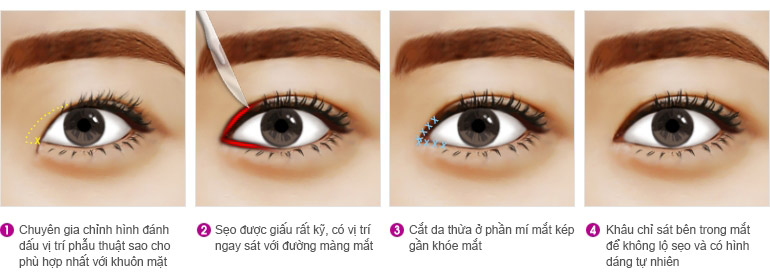 Mở rộng góc mắt công nghệ mới hạn chế sẹo tối đa - Ảnh 3