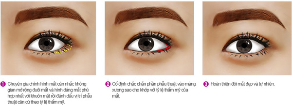 Mở rộng góc mắt công nghệ mới hạn chế sẹo tối đa - Ảnh 4