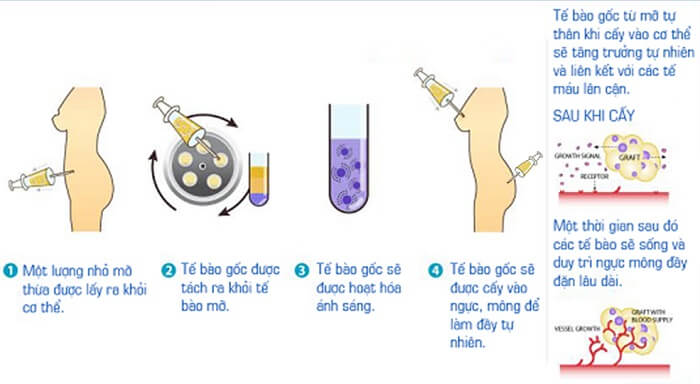 Có nên nâng ngực bằng mỡ tự thân không?_1