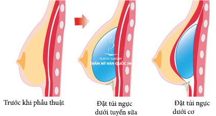 Nâng ngực 3D
