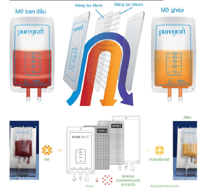 Công nghệ cấy mỡ tự thân hiện đại ứng dụng phương pháp chiết lọc mỡ Puregraft (Hoa Kỳ) đảm bảo an toàn trên mọi cơ địa (Ảnh mô phỏng).