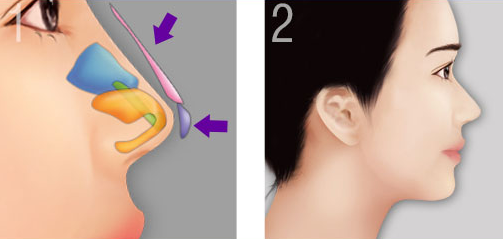 Sửa mũi ở bệnh viện tai mũi họng