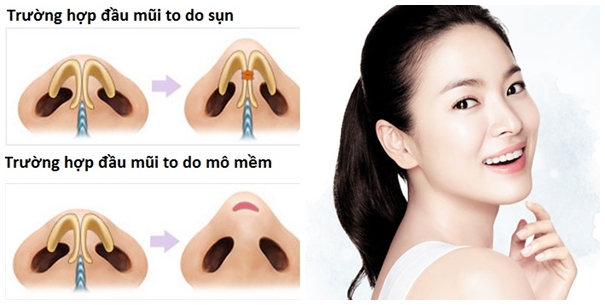Sửa mũi thon gọn Sửa mũi thon gọn