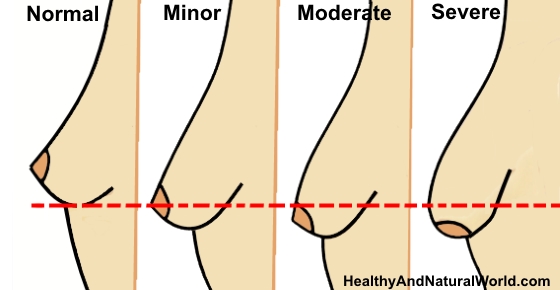 Nâng ngực mướp