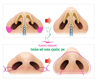 Video thu gọn cánh mũi nội soi-1