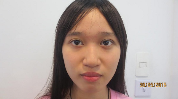 Bất ngờ với vẻ đẹp mới sau ca thẩm mỹ mắt sụp mi khó