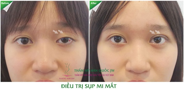 Bất ngờ với vẻ đẹp mới sau ca thẩm mỹ mắt sụp mi khó