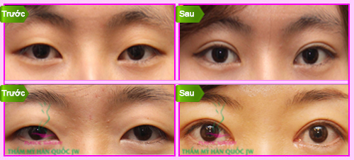 Sau khi bấm mí mắt Sau khi bấm mí mắt