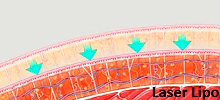 Hút mỡ bắp chân Hút mỡ bắp chân