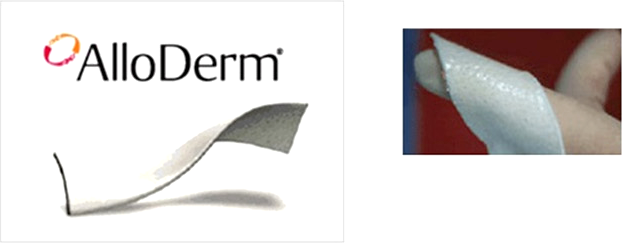 Nâng mũi bọc sụn Alloderm Nâng mũi bọc sụn Alloderm