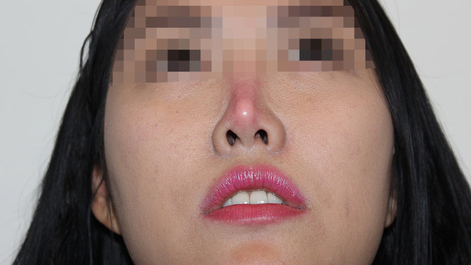 Nâng mũi có nguy hiểm không Nâng mũi có nguy hiểm không