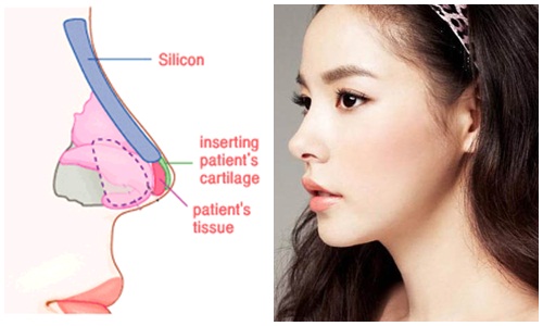 Nâng mũi và thu gọn cánh mũi Nâng mũi và thu gọn cánh mũi