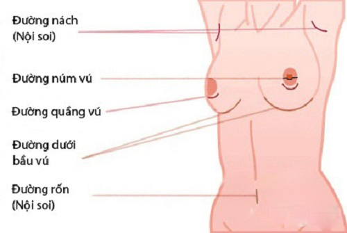 Phẫu thuật ngực hỏng Phẫu thuật ngực hỏng