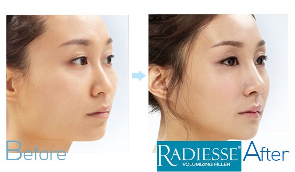 Nâng mũi Radies được bao lâu