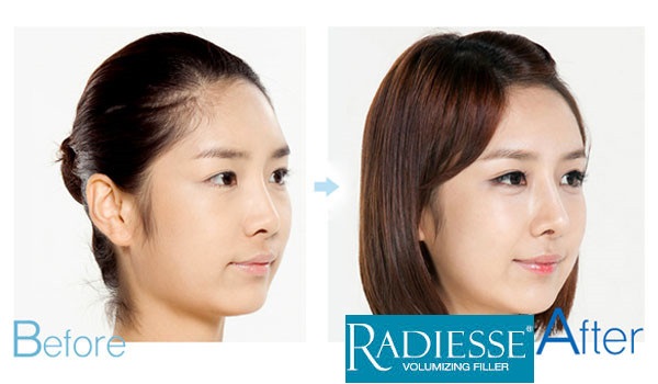 Nâng mũi Radies được bao lâu