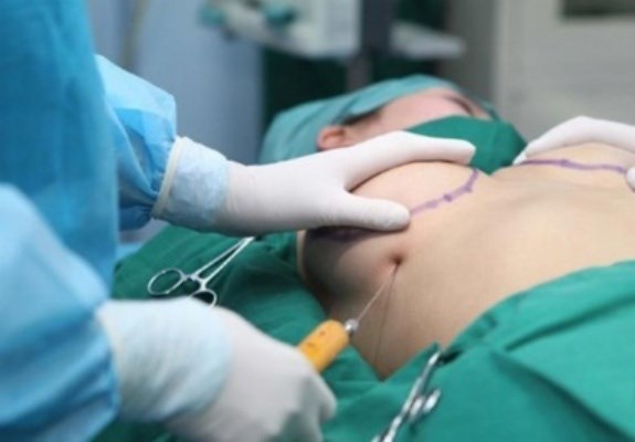 Nâng ngực hút mỡ
