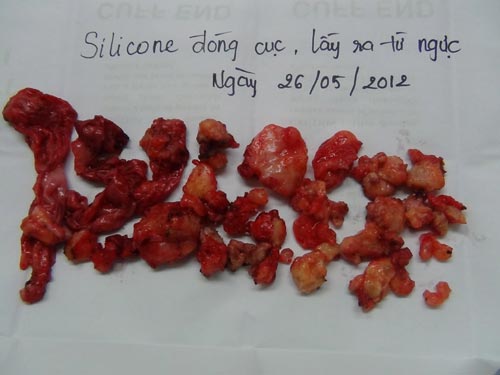 Nâng ngực siêu tốc