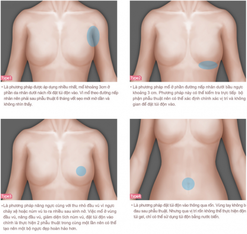 Nâng ngực tốt nhất