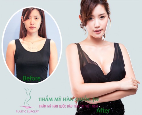 Nâng ngực tốt nhất
