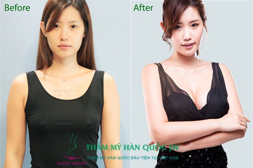 Phẫu thuật độn ngực