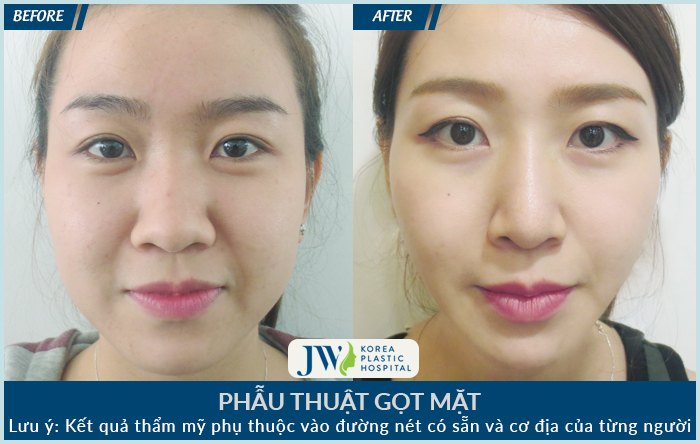 Phẫu thuật gọt mặt có nguy hiểm không?_6