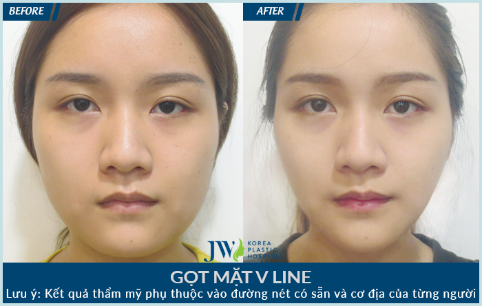 Phẫu thuật gọt mặt có nguy hiểm không?_7