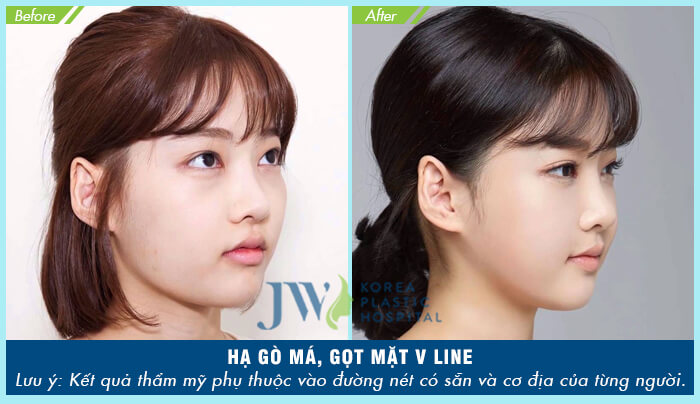 Phẫu thuật hạ gò má cao_4