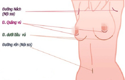 Chi phí phẫu thuật nâng ngực