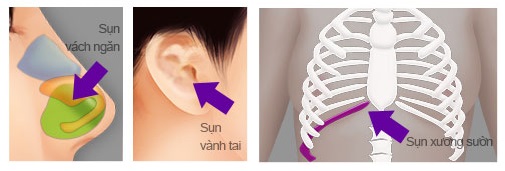Nâng mũi S line bằng sụn tự thân