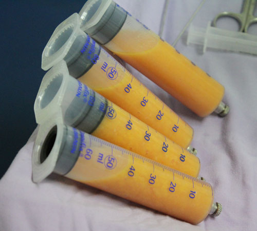 Nâng ngực không phẫu thuật