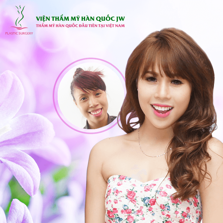 Địa chỉ phẫu thuật hàm hô uy tín