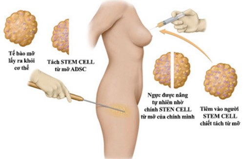 Nâng ngực nội soi hay cấy mỡ Nâng ngực nội soi hay cấy mỡ