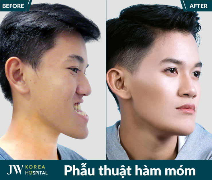 Phẫu thuật hàm móm tại Bệnh viện JW giúp điều chỉnh sai lệch xương hàm, cải thiện khớp cắn và cân đối khuôn mặt.