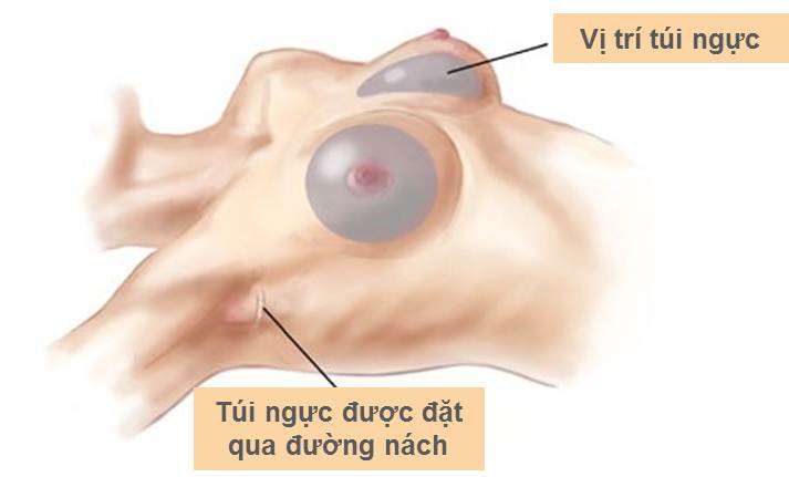 Quá trình phẫu thuật nâng ngực