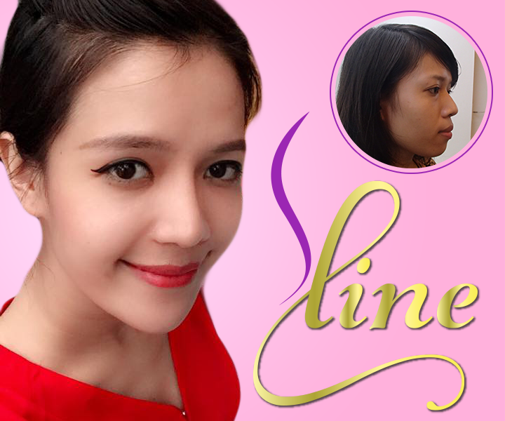 Sửa mũi cấu trúc