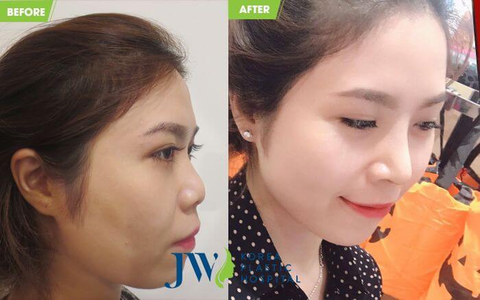 Nâng mũi có bị phá tướng không - Góc nhìn nhân tướng học - Ảnh 9