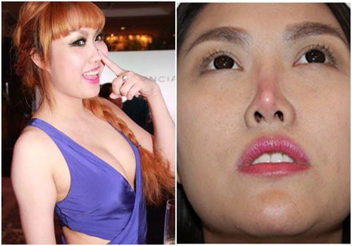 Sửa mũi lần 2 Sửa mũi lần 2