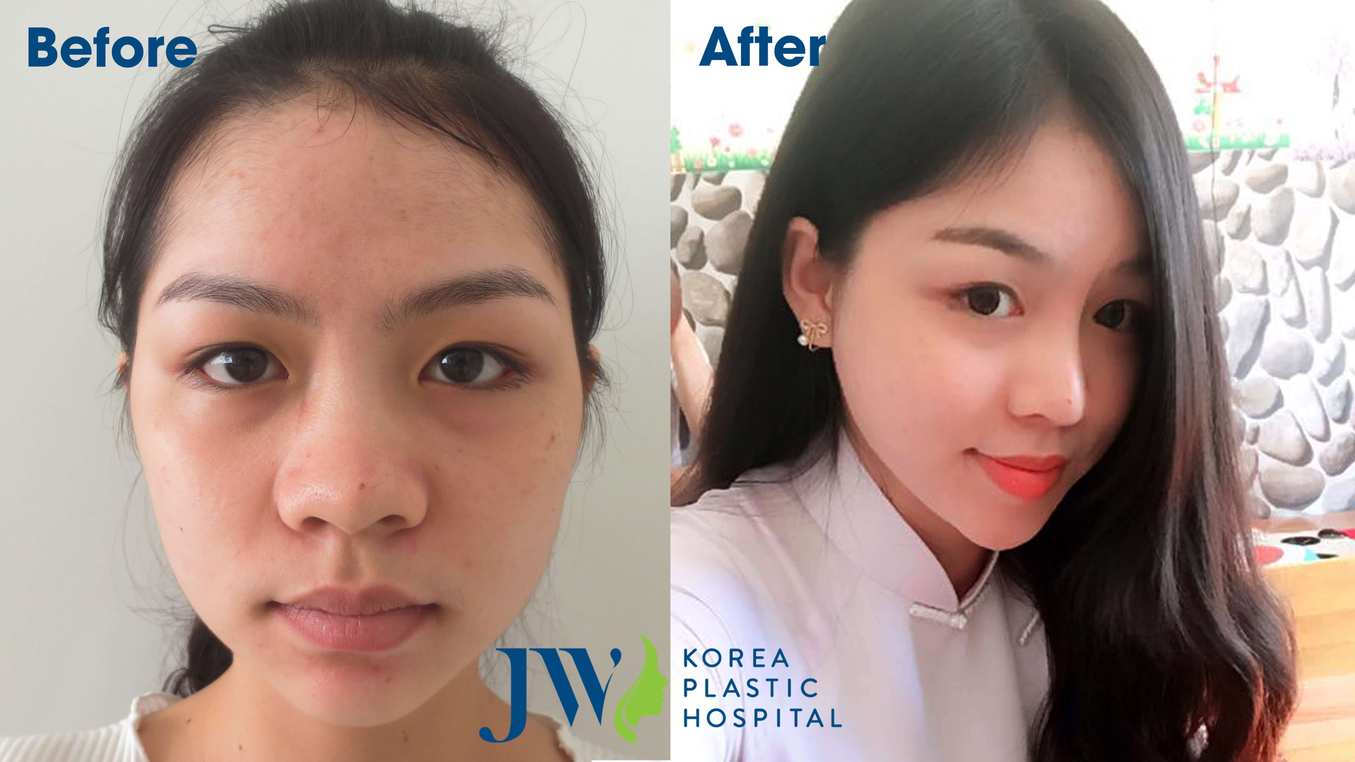 Nâng mũi có bị phá tướng không - Góc nhìn nhân tướng học - Ảnh 9