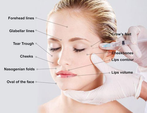 Nâng ngực bằng Filler