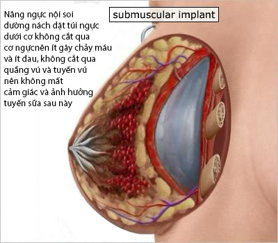 Nâng ngực ở đâu tốt nhất Nâng ngực ở đâu tốt nhất