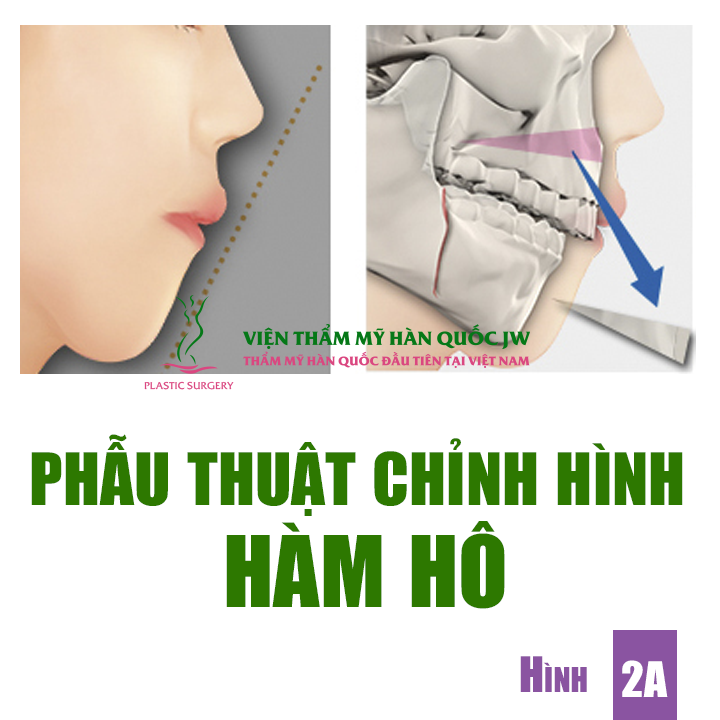 Nguyên nhân làm răng hô và cách khắc phục